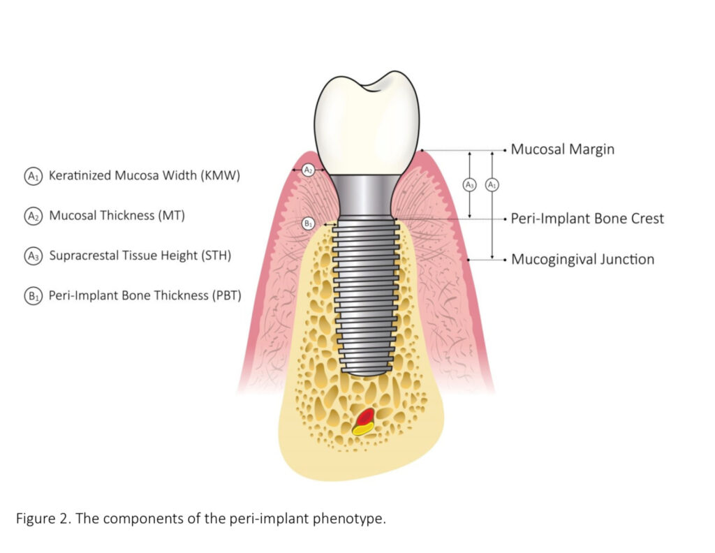 Phenotype mô quanh implant
